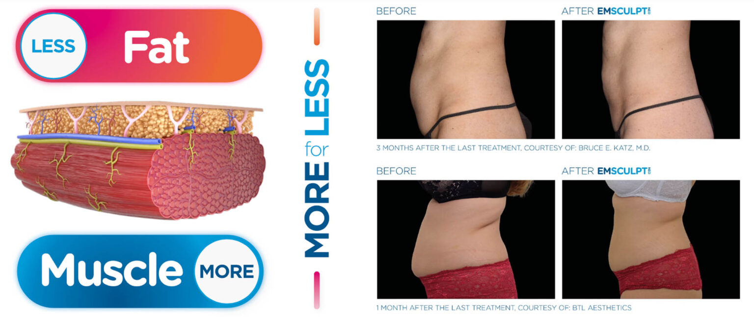 EMSCULPT-NEO-Procedure-1536x646 EMSCULPT NEO Procedure 1536x646 1