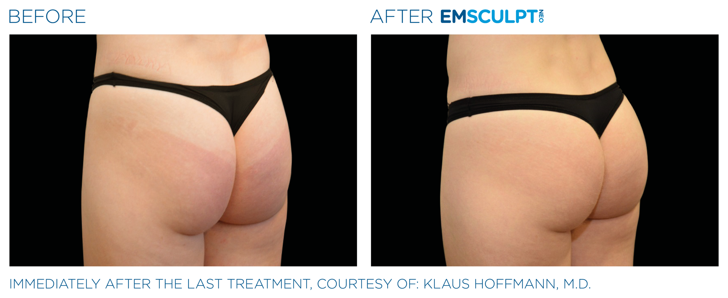 Before and After Image: Emsculpt Neo - left-back-oblique