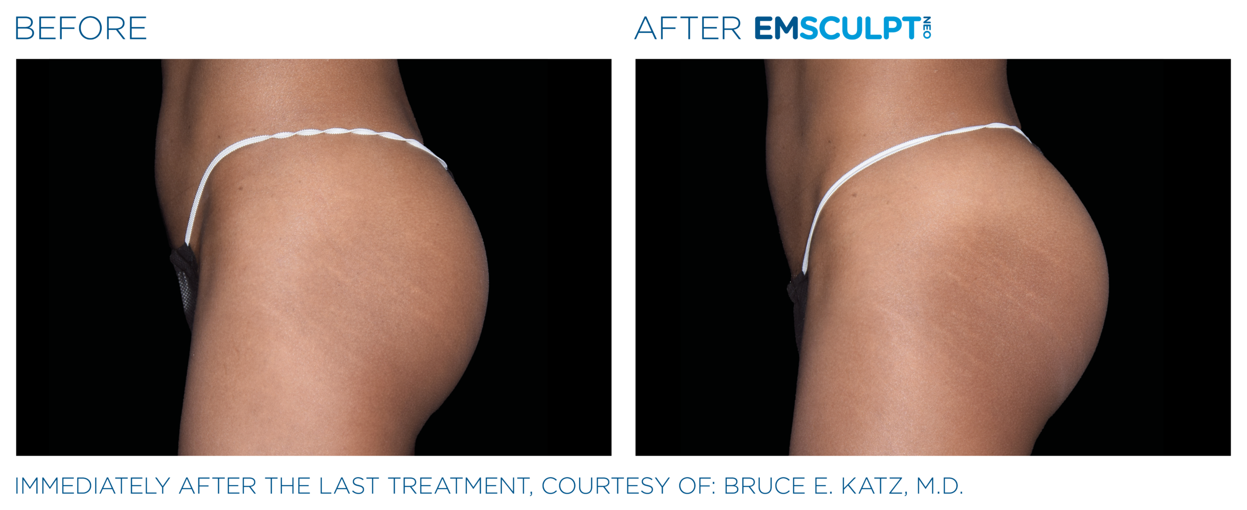 Before and After Image: Emsculpt Neo - left-side