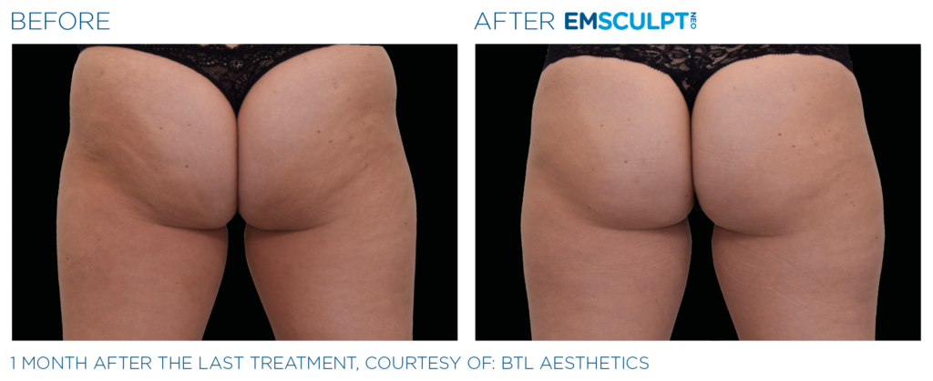 Before and After Image: Emsculpt Neo - back