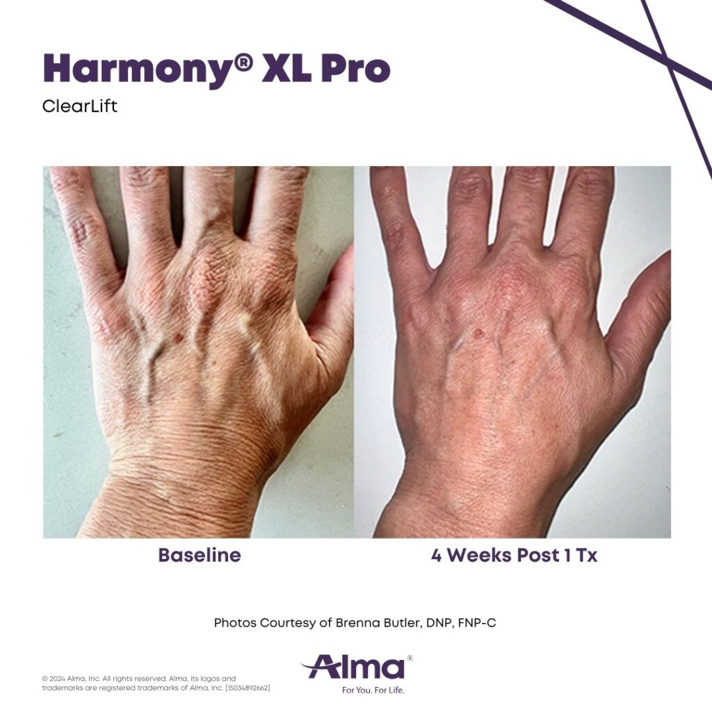 Before and After Image: ClearLift - back