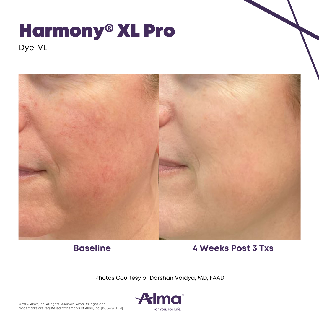 Before and After Image: Dye-VL - left-front-oblique