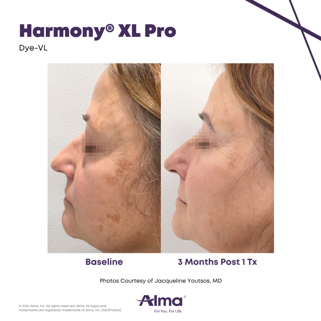 Before and After Image: Dye-VL - left-side