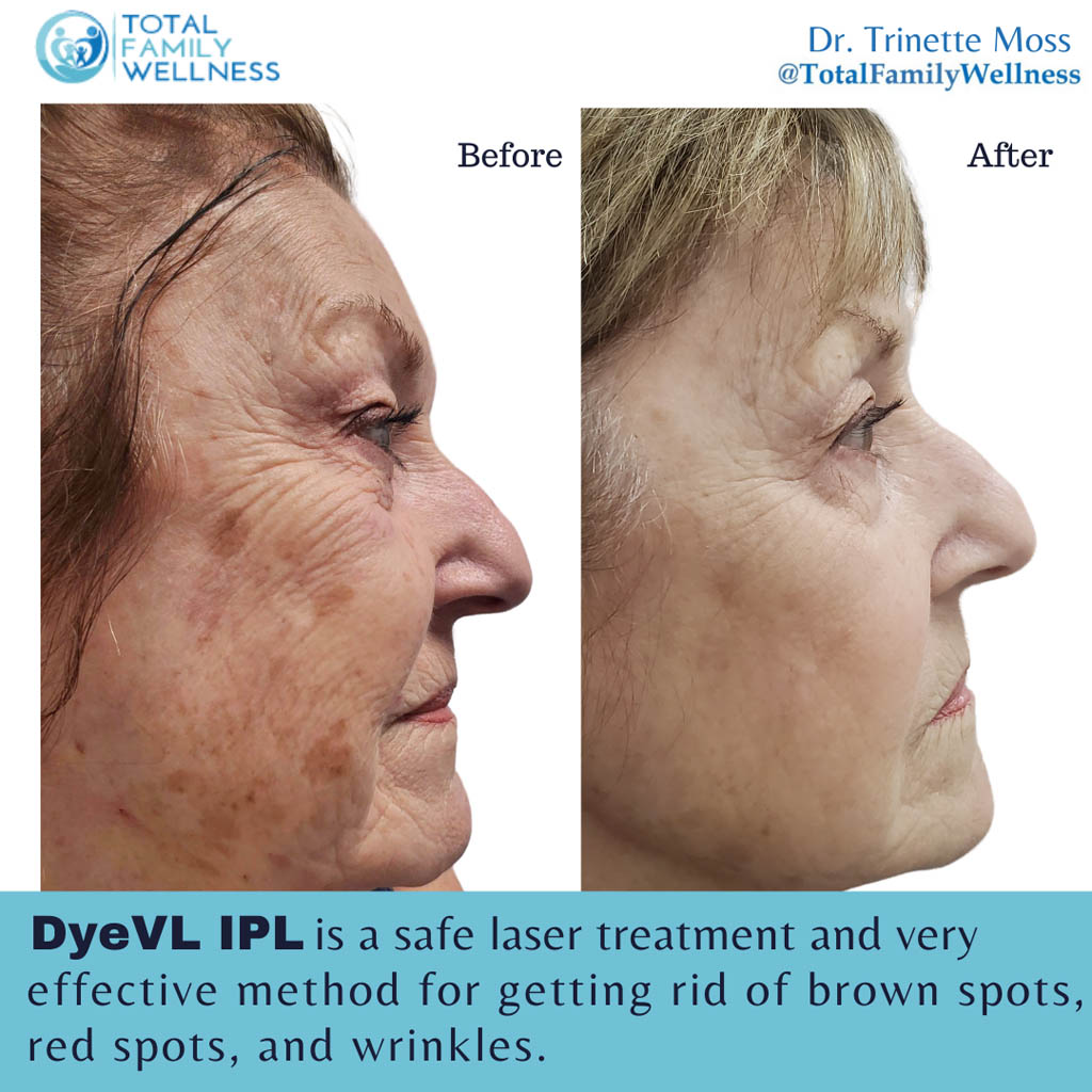 DyeVL IPL Before and After