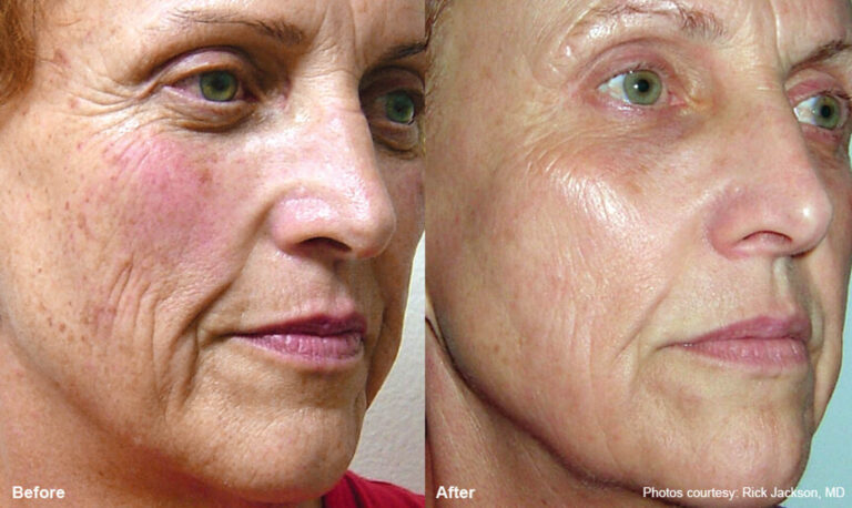 Erbium Resurfacing Before and After