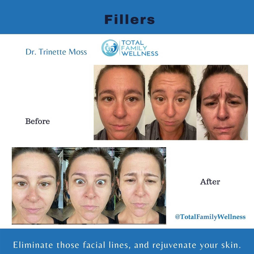 Fillers Before and After