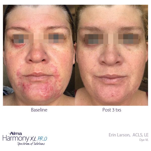 Laser Treatment Before and After Picture