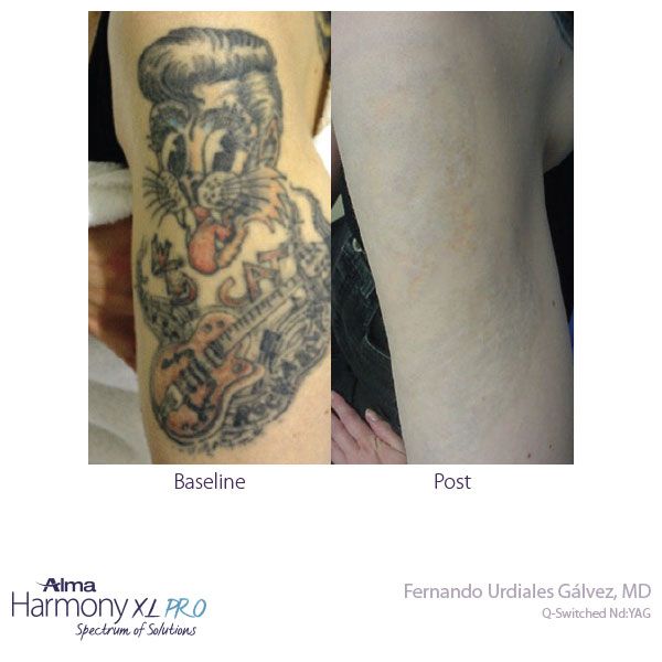 Laser Treatment Before and After Picture
