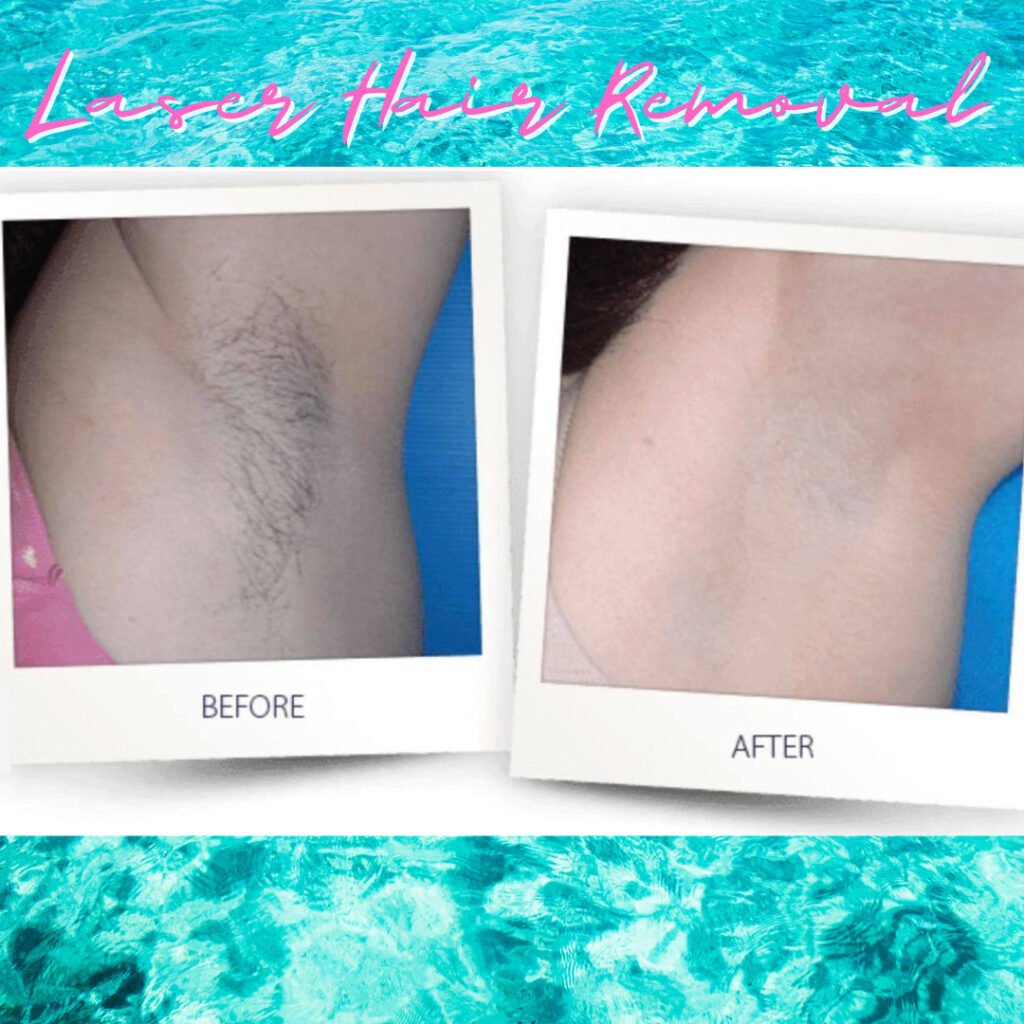 January Special 2021 Laser Hair Removal